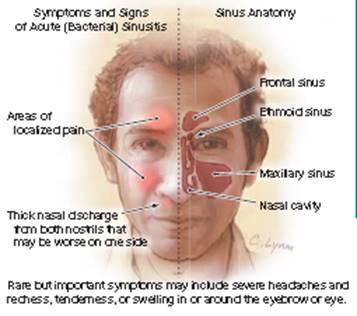 Sinusitis